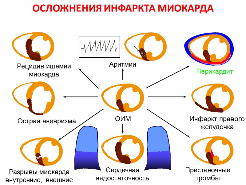 ОСЛОЖНЕНИЯ ИНФАРКТА МИОКАРДА